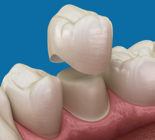 Временное протезирование зубов: зачем нужно и когда показано